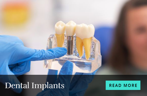 Dental-Implants