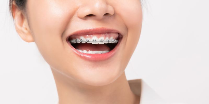 Braces Treatment in Chinchwad 