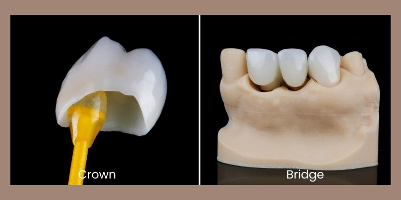 Crown and Bridges Treatment In Chinchwad