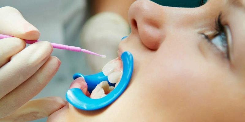 Fluoride Dental Treatment In Chinchwad