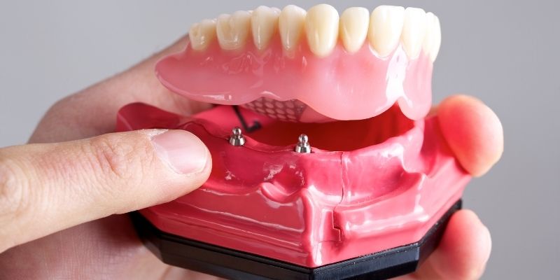 Over-dentures In Chinchwad