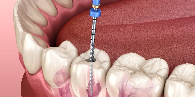 Root Canal Treatment In Chinchwad