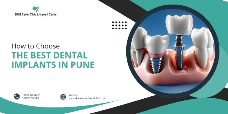 How to Choose the Best Dental Implants in Pune?