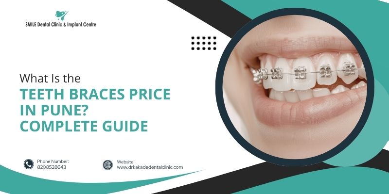 What Is the Teeth Braces Price in Pune? A Complete Guide