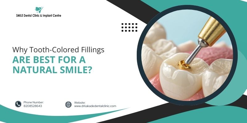 Why Tooth-Colored Fillings Are Best for a Natural Smile?